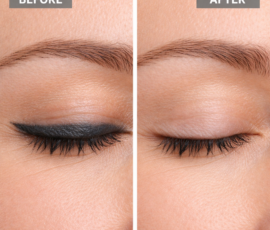 Before and after image for eyeliner tattoo removal