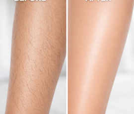 Laser hair removal in legs
