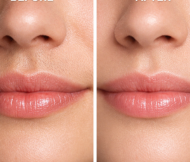 Laser hair removal for face