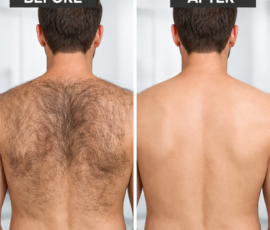 Laser hair removal for male back
