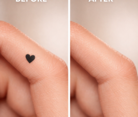 Before and after image for tattoo removal