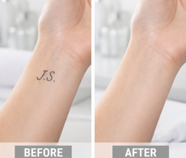 Before and After Image for Tattoo Removal