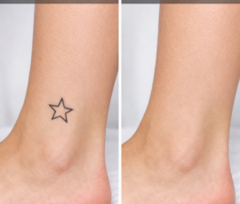 Tattoo Removal